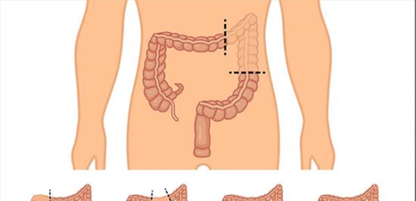 أسباب تتطلب استئصال القولون؟